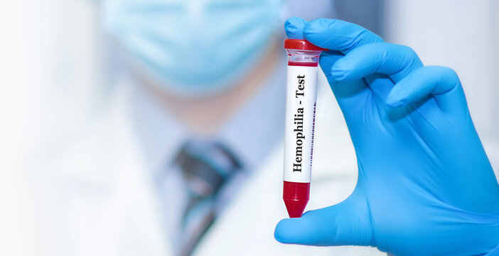 Doctor holding a test blood sample tube with Hemophilia test on the background of medical test tubes with analyzes.