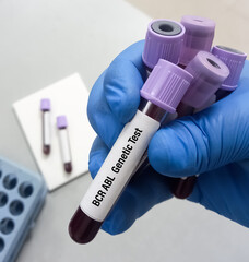 Blood sample for BCR ABL Genetic Test, used to diagnose CML, a type of leukemia. BCR-ABL 1 test.