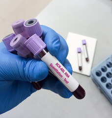 Blood sample for BCR ABL RNA quantitation Test, used to diagnose CML, a type of leukemia. BCR-ABL 1...