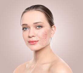 Woman with acne on her face on beige background. Zoomed area showing problem skin