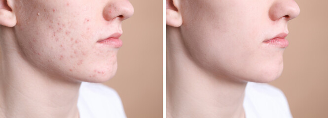 Acne problem. Young man before and after treatment on beige background, closeup. Collage of photos