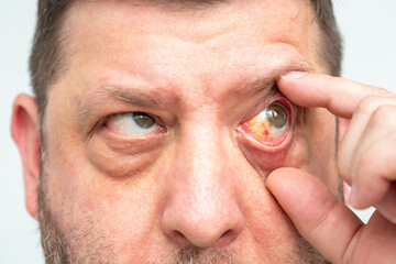 Redness of the eye, possible consequences of capillary rupture or infection, visible hemorrhage....