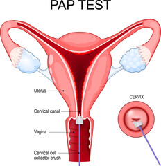Pap test procedure. Cross section of a human uterus. Close-up of a Cervix