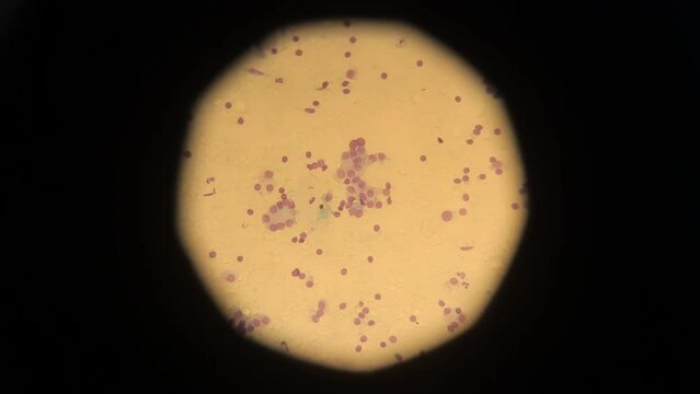 biopsy. biopsy results under a microscope. Human cancer cells under a microscope. human cells taken as a result of a biopsy for study in a laboratory using professional equipment. Anatomical theme.