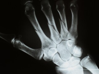 x ray of human hand