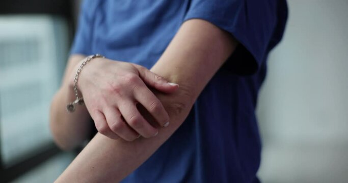 Woman scratches hand skin seeking relief from itching