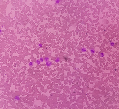 Photomicrograph show acute immuno-hemolytic anaemia. Cold hemagglutinin disease (CAD) should be excluded by Coomb's test, Serum LDH, Reticulocyte count.