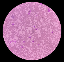 Photomicrograph show acute immuno-hemolytic anaemia. Cold hemagglutinin disease (CAD) should be...