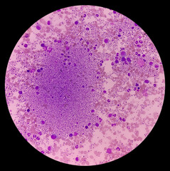 Essential thrombocytosis blood smear showing abnormal high volume of platelet and White Blood...