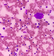 Bone marrow study. Panmyelosis. Myeloproliferative disorder. Thrombocytosis and neutrophilic...