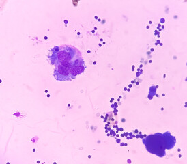 Ascitic fluid cytology. Leishman stain smear show Lymphocytes, polymorphs cells. Abnormal cells....