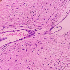 Fibromyxoma. Leg tissue biopsy: Sections microscopically show features of fibromyxoma. Superficial...