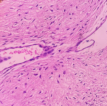 Fibromyxoma. Leg tissue biopsy: Sections microscopically show features of fibromyxoma. Superficial Acral Fibromyxoma, rare slow growing myxoid tumor.