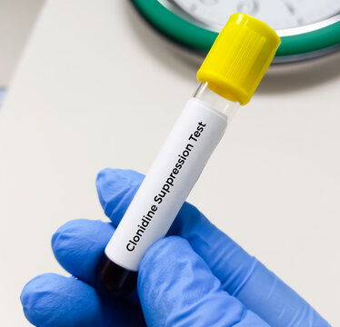 Blood sample for Clonidine Suppression test to diagnosis of pheochromocytoma. Catecholamine-secreting tumor of chromaffin cells.