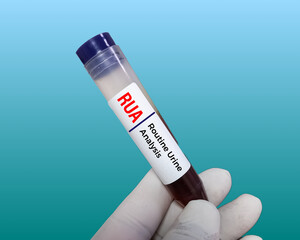 Urine sample for RUA (Routine Urine Analysis) test. Urine RE test. urinalysis.