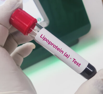 Blood sample for lipoprotein (a) or LpA blood test. Lipid profile. to diagnosis of high risk for heart disease and stroke. Bad cholesterol medical testing concept.