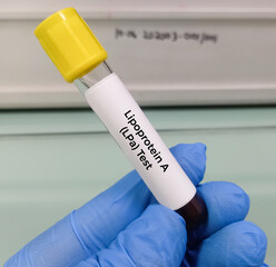 Blood sample for lipoprotein (a) or LpA blood test. Lipid profile. to diagnosis of high risk for...