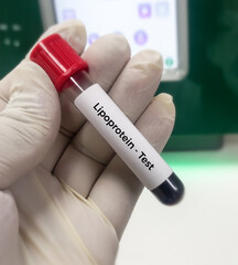 Blood sample for lipoprotein test. Lipid profile. to diagnosis of high risk for heart disease and stroke. Bad cholesterol medical testing concept.