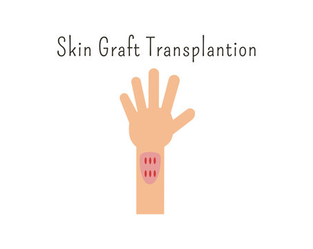 Human organ donation for transplantation concept with hand, suitable for medical banner, infographics and education. Skin graft transplantation. organ donation concept. 