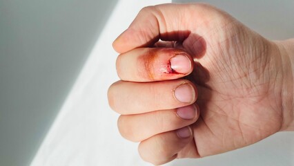 the right hand after a dog bite on the index finger is bent into a fist on a light background. view...