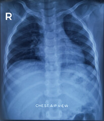 Pneumonitis(right), CXR (Chest X-Ray) PA view. Hypersensitivity pneumonitis.