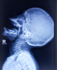 X-ray of nasopharynx lateral view show Enlarged adenoid. Small lobulated dense homogeneous. - obrazy, fototapety, plakaty