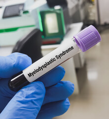 Blood sample for Myelodysplastic syndrome test. To diagnose MDS – a full blood count and a bone marrow biopsy.