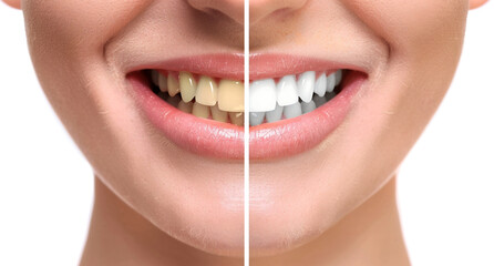 Woman's smiling mouth is divided into two parts, one with teeth that have dark yellowish tones and the other part showing white healthy teeth, This concept represents professional dental whitening. 