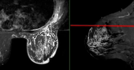 Breast MRI revealing BI-RADS 4 in women indicates suspicious findings warranting further investigation for potential malignancy.