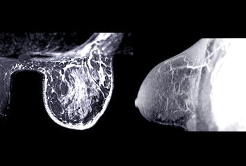 Breast MRI revealing BI-RADS 4 in women indicates suspicious findings warranting further investigation for potential malignancy.