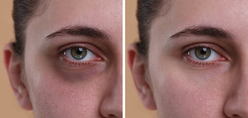 Collage with photos of woman with dark circle under eye before and after treatment on beige...
