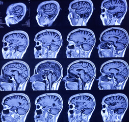 MRI (Magnetic Resonance Image) of brain. Cerebral cortical atrophy.