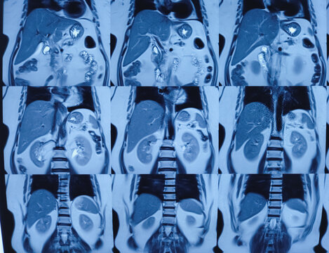 MRCP film of MRI of abdomen. Hepatic parenchymal tiny calcification, hepaticolithiasis. Liver, bile duct, pancreas duct for medical health diagnosis.