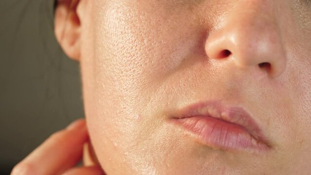 Problem skin with dilated and enlarged pores. Close-up of a woman face. Oily skin. oily shine
