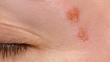Skin healing period after erbium laser facial resurfacing. Young woman suffering from problem skin....