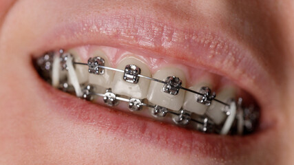 Close up of teeth with braces, orthodontic treatment concept, dental healthcare background