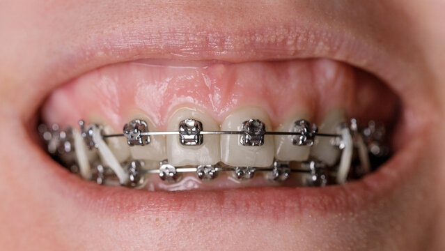 Metal orthodontic braces on crooked teeth close-up. Gummy smile. Dental concept, medicinal alignment of teeth, brackets orthodontist