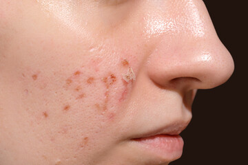 Skin healing period after erbium laser facial resurfacing. Young woman suffering from problem skin....