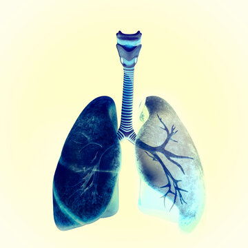 X-ray view of lungs and trachea, lung infection. Pneumonia. 3d rendering
