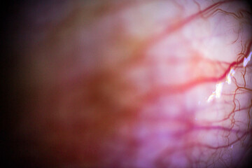 Red curved broken vessels in the human eye in macro	

