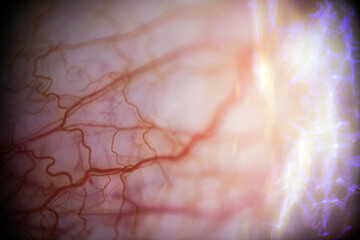 Many burst red blood vessels of the eye in macro	
