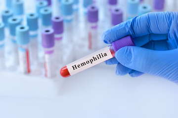 Doctor holding a test blood sample tube with Hemophilia test on the background of medical test tubes with analyzes.