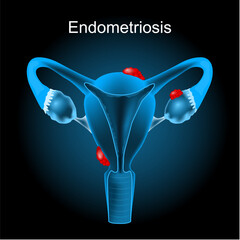 Endometriosis. Cross section of a human uterus