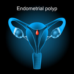 Endometrial polyp. Cross section of a human uterus with Uterine polyp