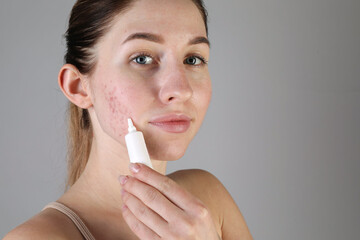 Young woman with acne problem applying cosmetic product onto her skin on light grey background....