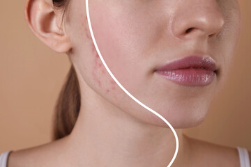 Acne problem, collage. Photo of woman divided into halves before and after treatment on beige background, closeup