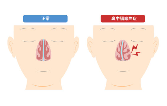 鼻中膈の変形によって起こる鼻中膈弯曲症のイラスト