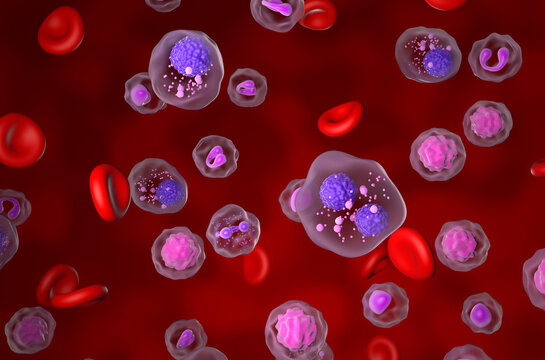 Multiple myeloma (MM) - isometric view 3d illustration