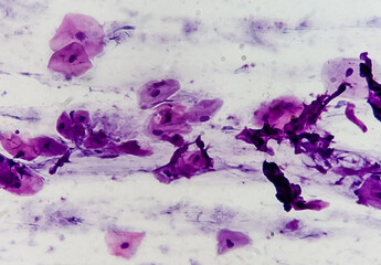 Light micrograph of a vaginal smear showing adenocarcinoma cells (center). Vaginal cancer....