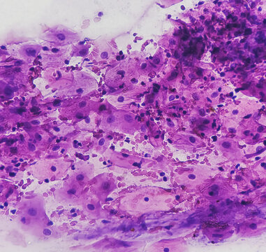 Light micrograph of a vaginal smear showing adenocarcinoma cells (center). Vaginal cancer. Inflammatory smear with HPV related changes. Cervical cancer. SCC.
